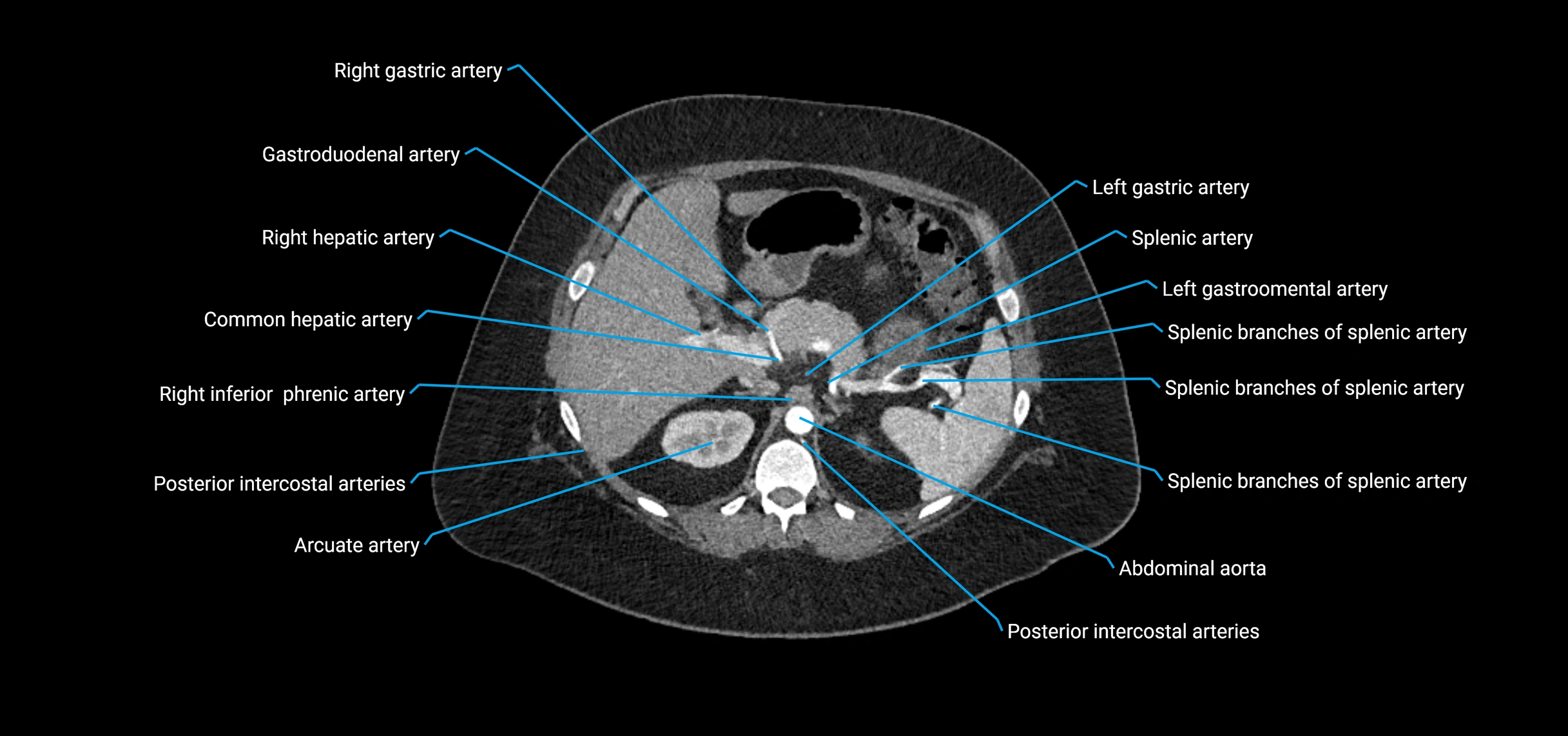 CTA abdomen axial cross sectional anatomy labelled image_49 (2).webp